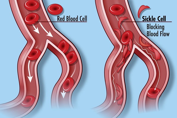 sickle cell treatment and problems
