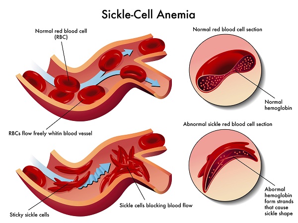 scheme of red blood cells affected by sickle cell anemia